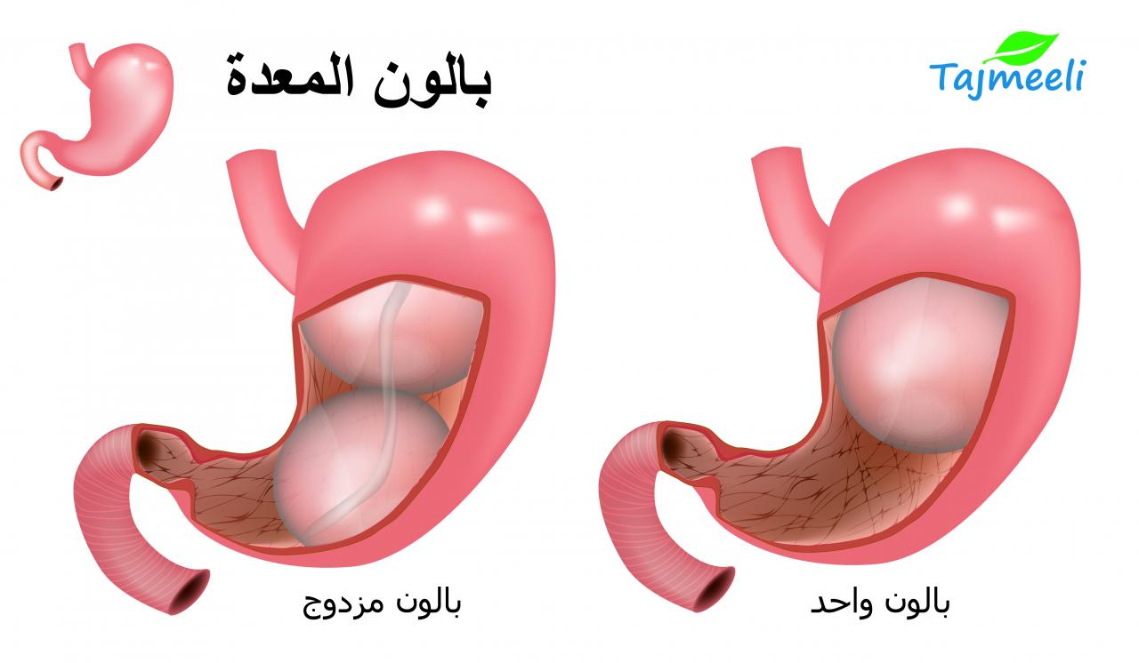 تجربتي مع بالون المعدة , ما هي خطوره بالونه المعده